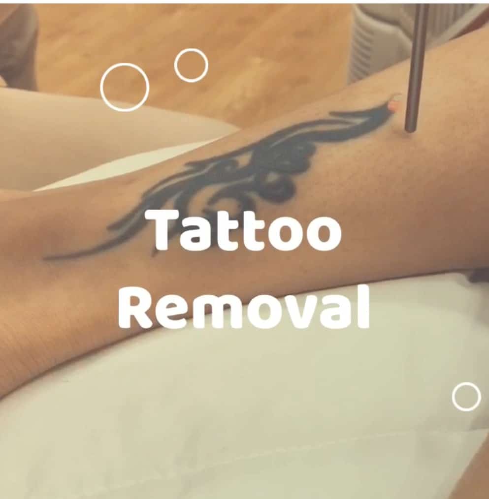 Tattoo Removal Laser  Chicago PicoSure  Derick Dermatology
